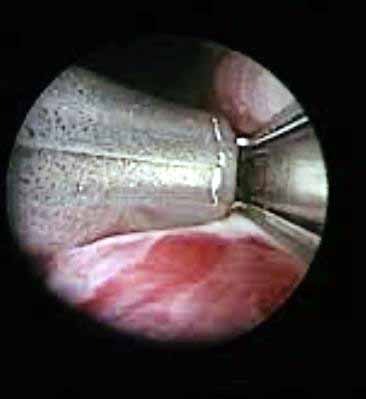 Vadodara city’s first ‘Urolift’ procedure successfully performed at Zydus Hospital